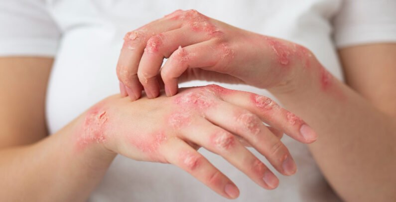 What Are the 7 Different Types of Eczema?