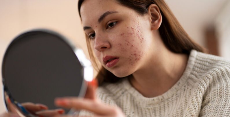 Everything You Want to Know About Acne